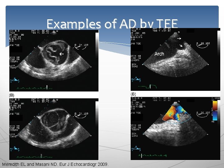 Examples of AD by TEE Meredith EL and Masani ND. Eur J Echocardiogr 2009.