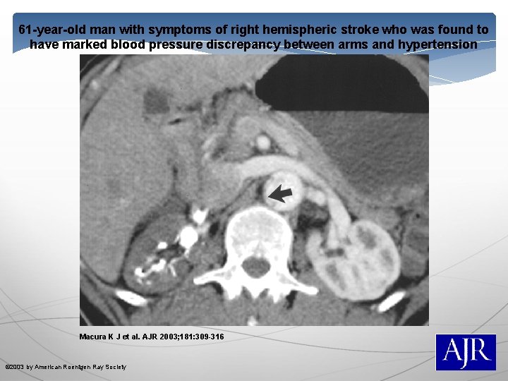 61 -year-old man with symptoms of right hemispheric stroke who was found to have