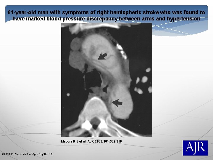 61 -year-old man with symptoms of right hemispheric stroke who was found to have