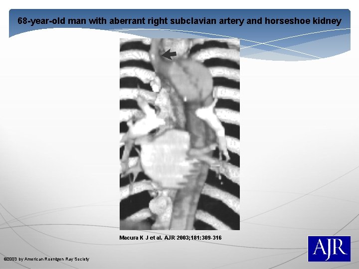 68 -year-old man with aberrant right subclavian artery and horseshoe kidney Macura K J