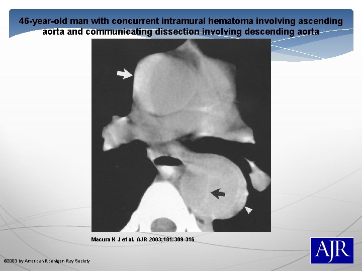46 -year-old man with concurrent intramural hematoma involving ascending aorta and communicating dissection involving