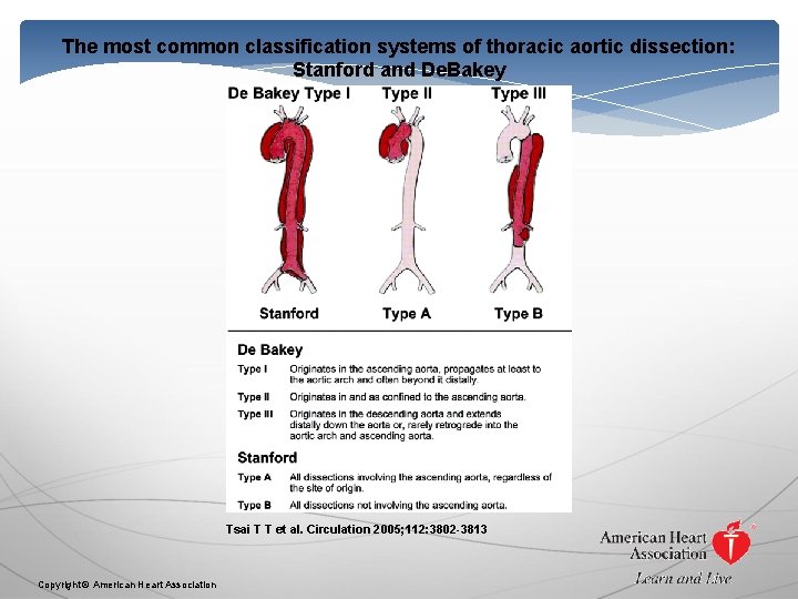 The most common classification systems of thoracic aortic dissection: Stanford and De. Bakey Tsai