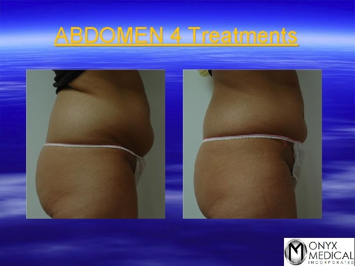 ABDOMEN 4 Treatments 