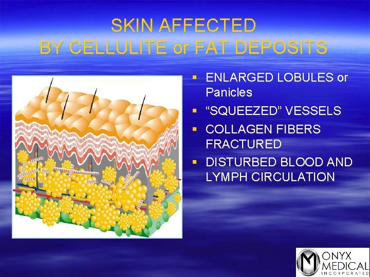 SKIN AFFECTED BY CELLULITE or FAT DEPOSITS § ENLARGED LOBULES or Panicles § “SQUEEZED”