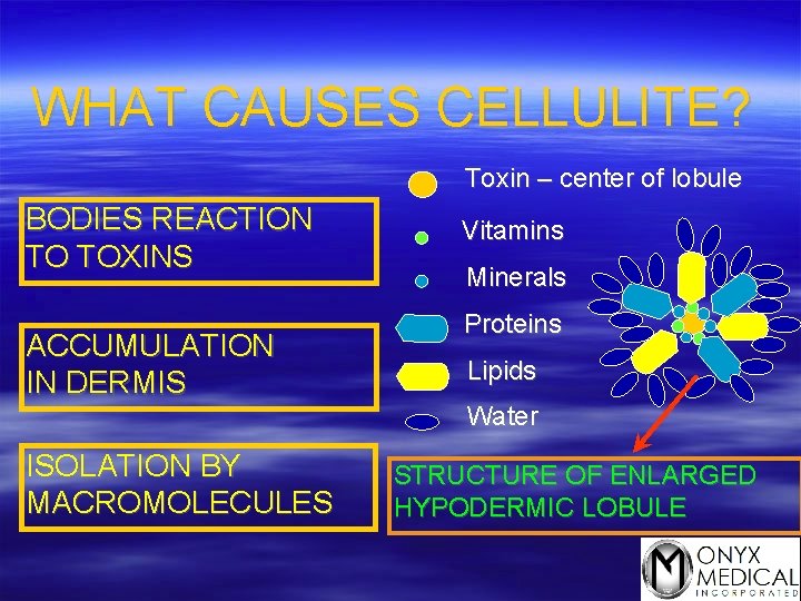 WHAT CAUSES CELLULITE? Toxin – center of lobule BODIES REACTION TO TOXINS ACCUMULATION IN