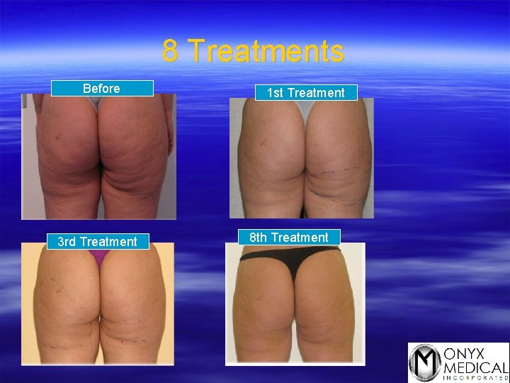 8 Treatments Before 3 rd Treatment 1 st Treatment 8 th Treatment 