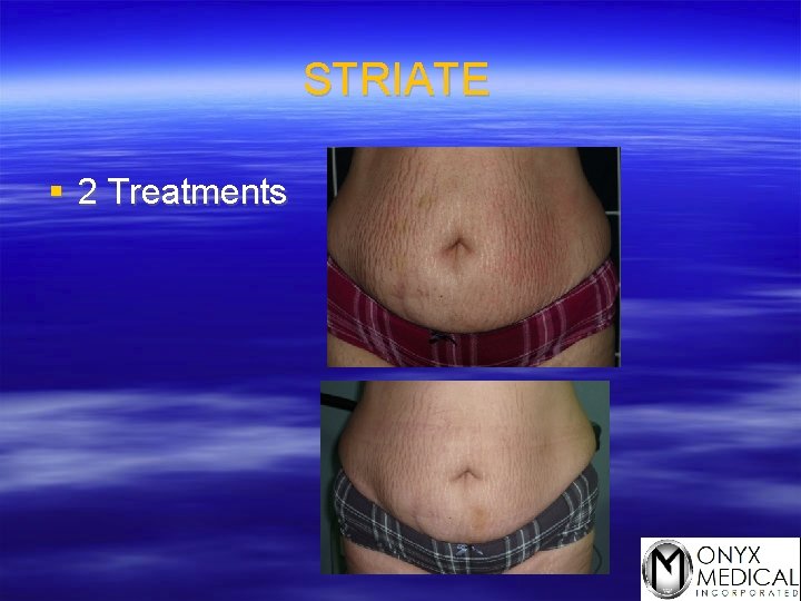 STRIATE § 2 Treatments 