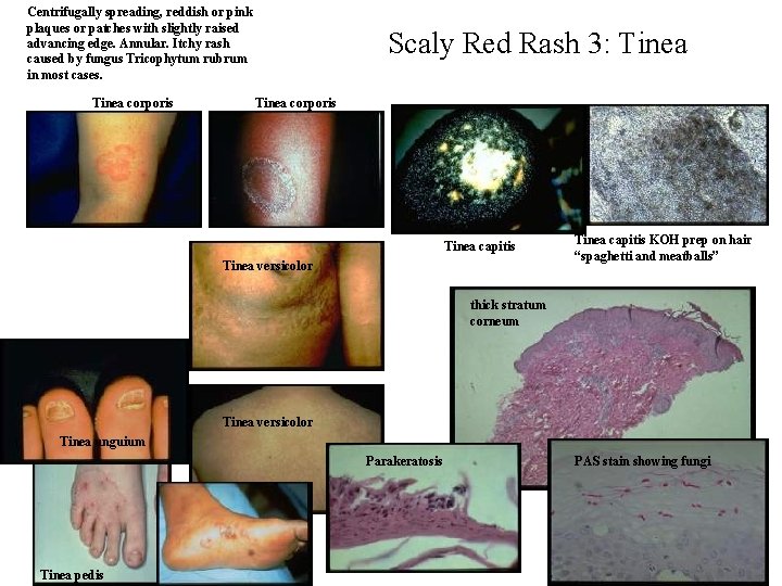 Centrifugally spreading, reddish or pink plaques or patches with slightly raised advancing edge. Annular. Centrifugally spreading, reddish or pink plaques or patches with slightly raised advancing edge. Annular.