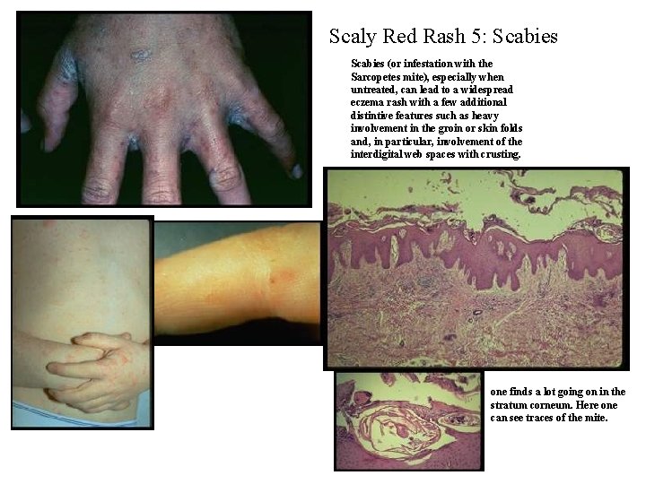 Scaly Red Rash 5: Scabies (or infestation with the Sarcopetes mite), especially when untreated, Scaly Red Rash 5: Scabies (or infestation with the Sarcopetes mite), especially when untreated,