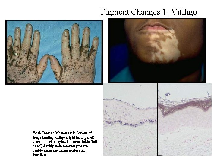 Pigment Changes 1: Vitiligo With Fontana Masson stain, lesions of long standing vitiligo (right Pigment Changes 1: Vitiligo With Fontana Masson stain, lesions of long standing vitiligo (right