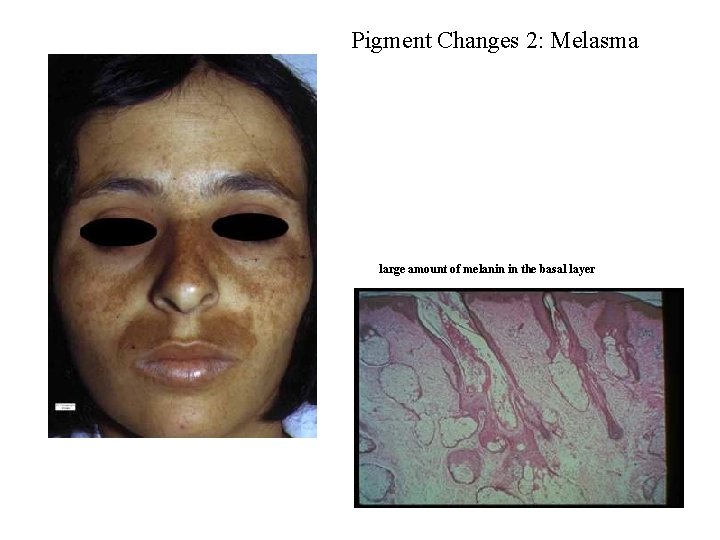 Pigment Changes 2: Melasma large amount of melanin in the basal layer Pigment Changes 2: Melasma large amount of melanin in the basal layer
