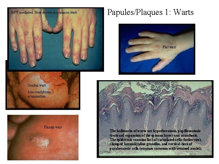 HPV mediated. Here shown is common wart Papules/Plaques 1: Warts Flat wart Genital wart HPV mediated. Here shown is common wart Papules/Plaques 1: Warts Flat wart Genital wart