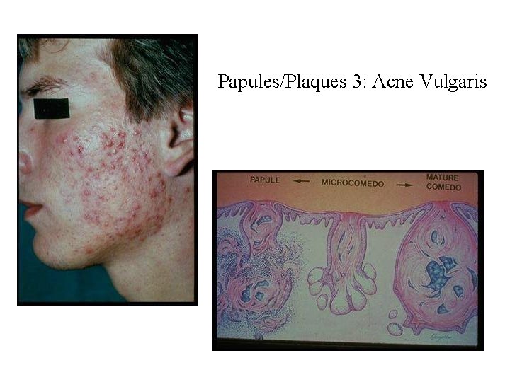 Papules/Plaques 3: Acne Vulgaris Papules/Plaques 3: Acne Vulgaris