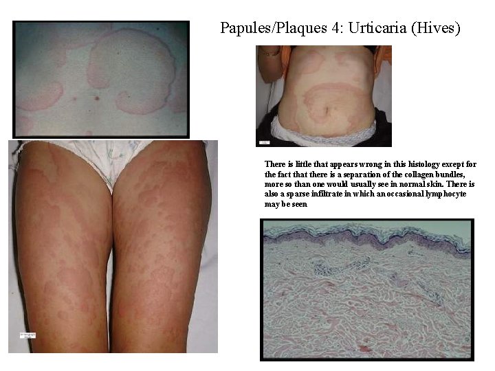 Papules/Plaques 4: Urticaria (Hives) There is little that appears wrong in this histology except Papules/Plaques 4: Urticaria (Hives) There is little that appears wrong in this histology except