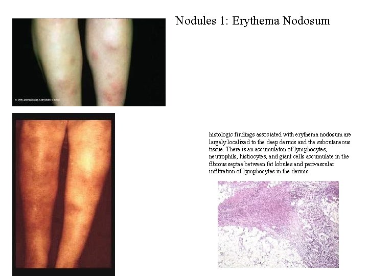 Nodules 1: Erythema Nodosum histologic findings associated with erythema nodosum are largely localized to Nodules 1: Erythema Nodosum histologic findings associated with erythema nodosum are largely localized to
