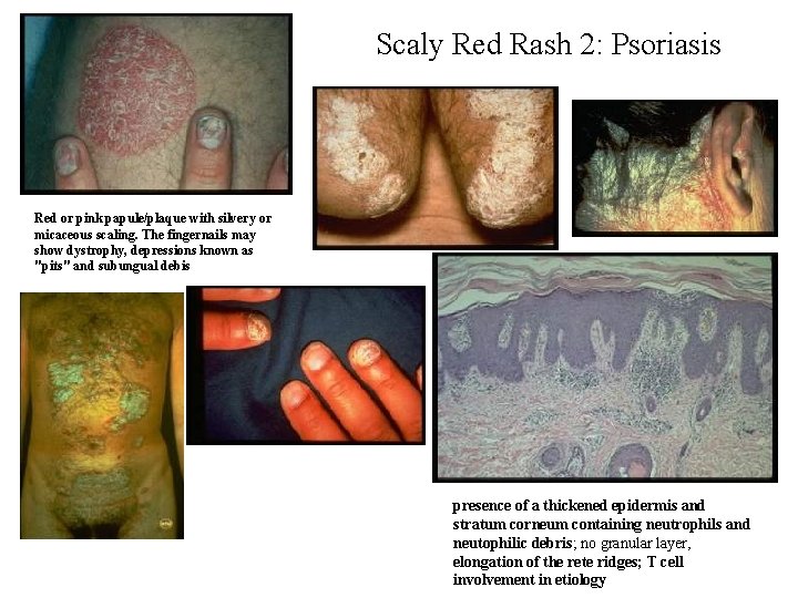 Scaly Red Rash 2: Psoriasis Red or pink papule/plaque with silvery or micaceous scaling. Scaly Red Rash 2: Psoriasis Red or pink papule/plaque with silvery or micaceous scaling.
