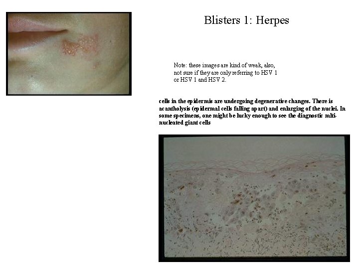 Blisters 1: Herpes Note: these images are kind of weak, also, not sure if Blisters 1: Herpes Note: these images are kind of weak, also, not sure if