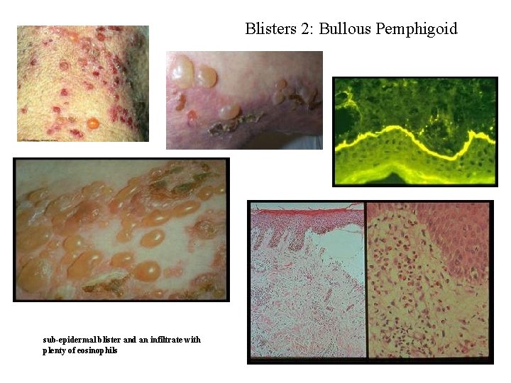 Blisters 2: Bullous Pemphigoid sub-epidermal blister and an infiltrate with plenty of eosinophils Blisters 2: Bullous Pemphigoid sub-epidermal blister and an infiltrate with plenty of eosinophils