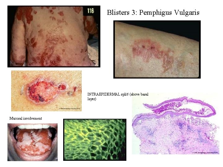 Blisters 3: Pemphigus Vulgaris INTRAEPIDERMAL split! (above basal layer) Mucosal involvement Blisters 3: Pemphigus Vulgaris INTRAEPIDERMAL split! (above basal layer) Mucosal involvement