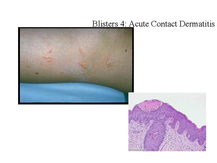 Blisters 4: Acute Contact Dermatitis Blisters 4: Acute Contact Dermatitis