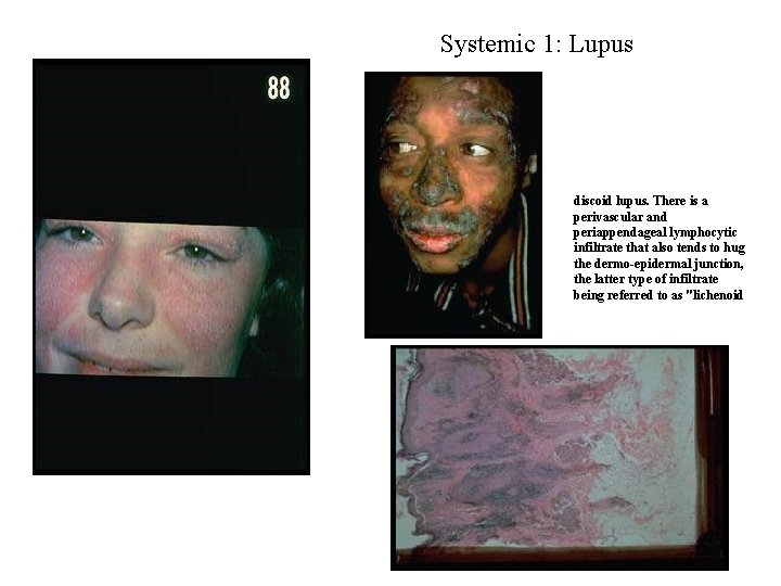 Systemic 1: Lupus discoid lupus. There is a perivascular and periappendageal lymphocytic infiltrate that Systemic 1: Lupus discoid lupus. There is a perivascular and periappendageal lymphocytic infiltrate that