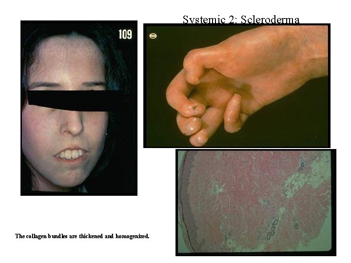 Systemic 2: Scleroderma The collagen bundles are thickened and homogenized. Systemic 2: Scleroderma The collagen bundles are thickened and homogenized.
