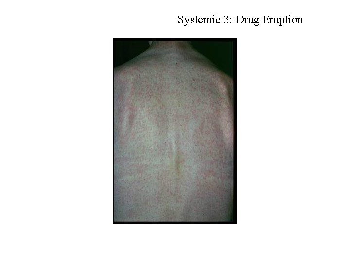Systemic 3: Drug Eruption Systemic 3: Drug Eruption