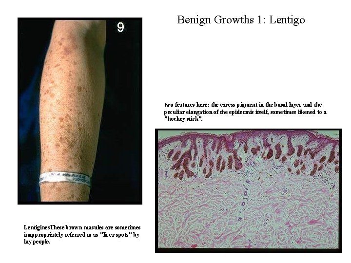 Benign Growths 1: Lentigo two features here: the excess pigment in the basal layer Benign Growths 1: Lentigo two features here: the excess pigment in the basal layer