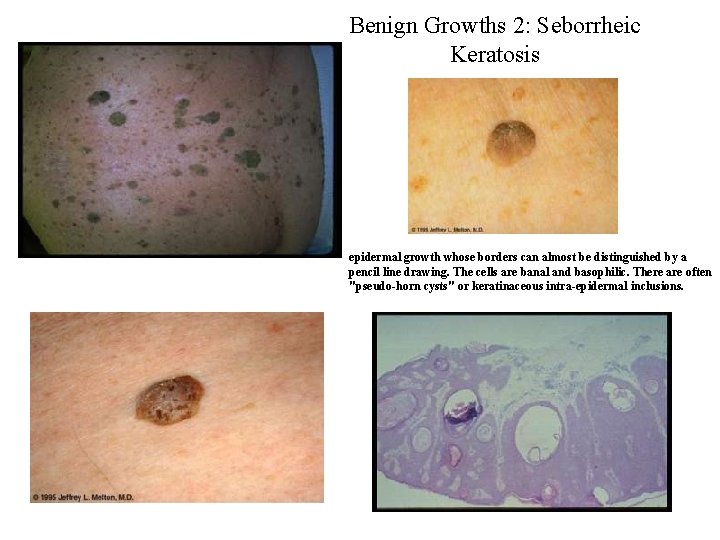 Benign Growths 2: Seborrheic Keratosis epidermal growth whose borders can almost be distinguished by Benign Growths 2: Seborrheic Keratosis epidermal growth whose borders can almost be distinguished by
