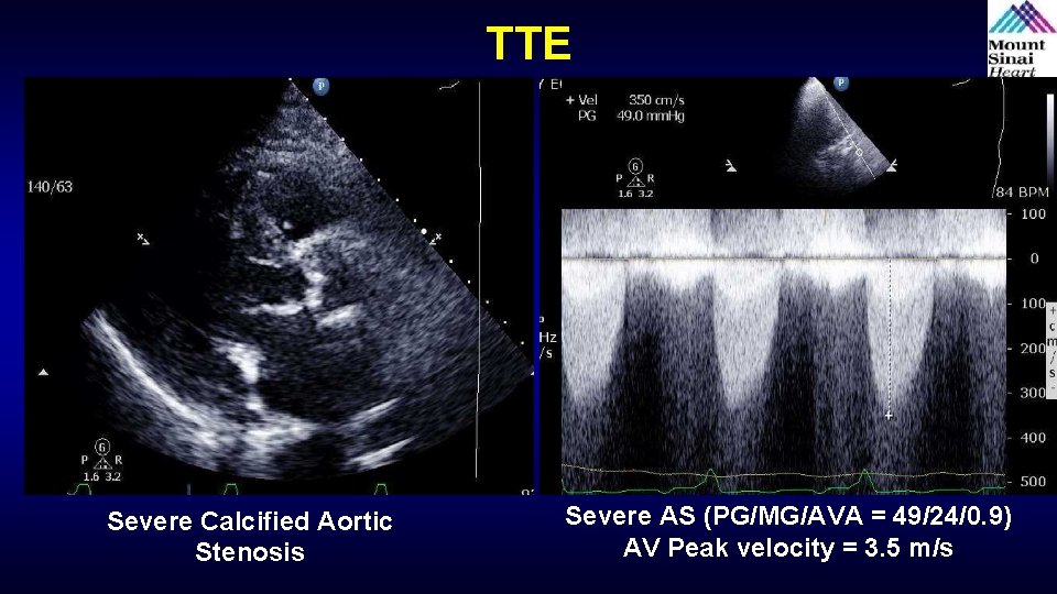 TTE Severe Calcified Aortic Stenosis Severe AS (PG/MG/AVA = 49/24/0. 9) AV Peak velocity