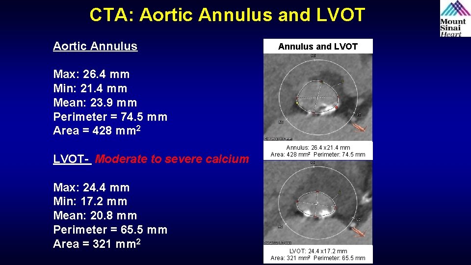 CTA: Aortic Annulus and LVOT Max: 26. 4 mm Min: 21. 4 mm Mean: