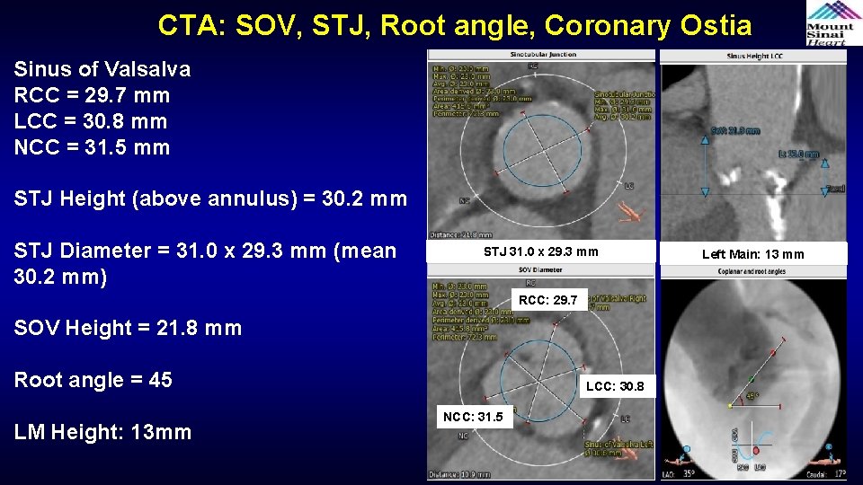 CTA: SOV, STJ, Root angle, Coronary Ostia Sinus of Valsalva RCC = 29. 7