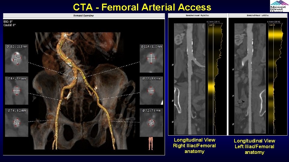 CTA - Femoral Arterial Access Longitudinal View Right Iliac/Femoral anatomy Longitudinal View Left Iliac/Femoral