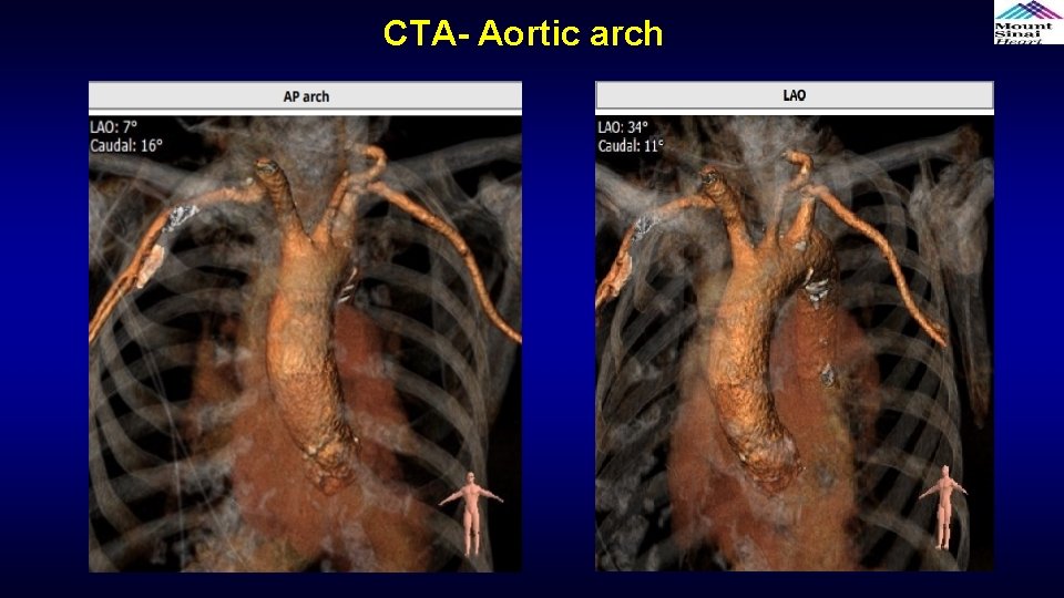 CTA- Aortic arch 