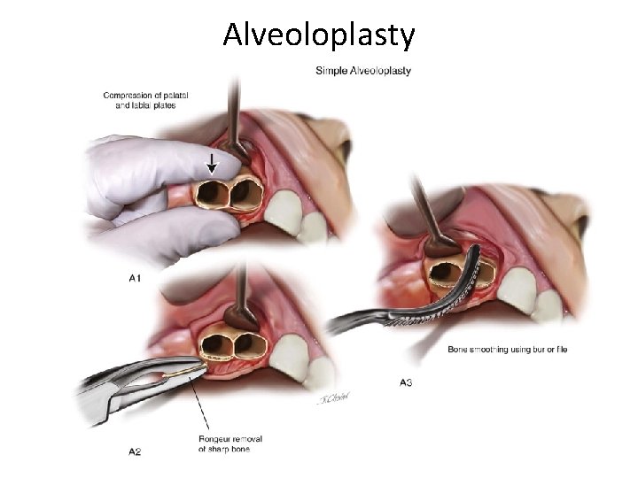 Alveoloplasty 
