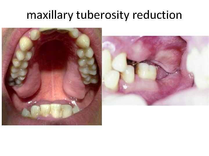 maxillary tuberosity reduction 