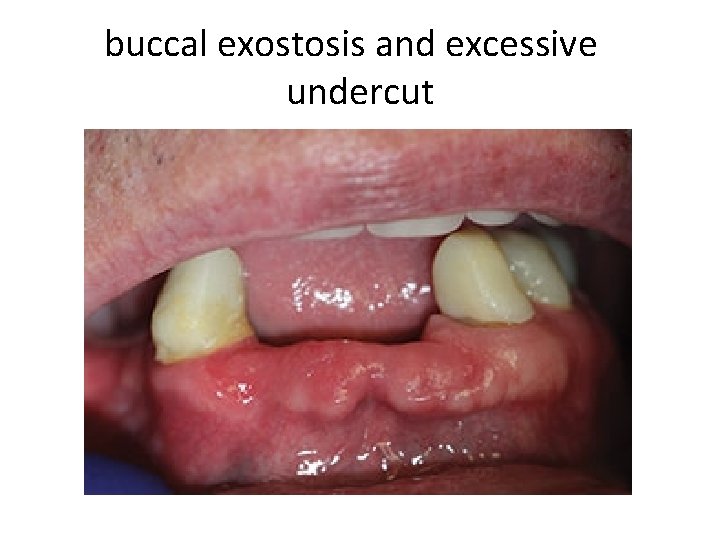 buccal exostosis and excessive undercut 
