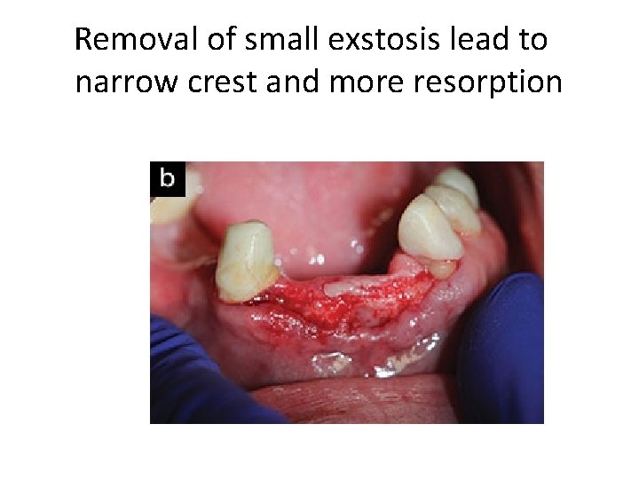 Removal of small exstosis lead to narrow crest and more resorption 