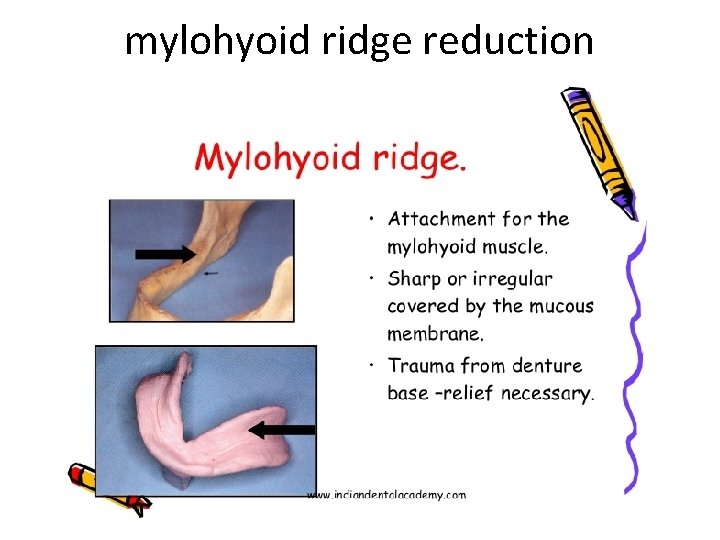 mylohyoid ridge reduction 