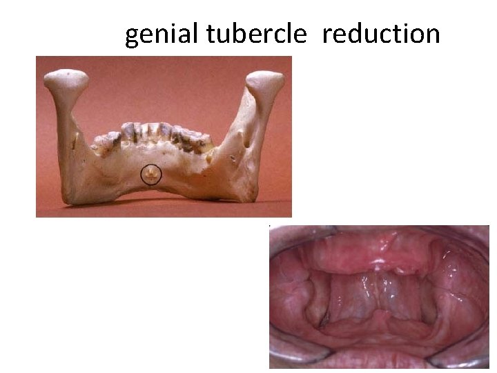 genial tubercle reduction 