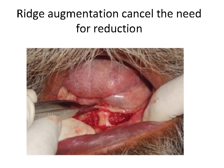 Ridge augmentation cancel the need for reduction 