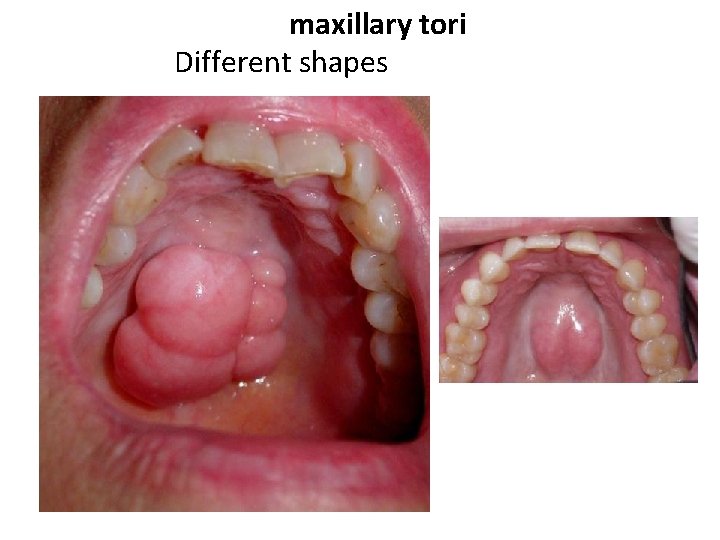 maxillary tori Different shapes 