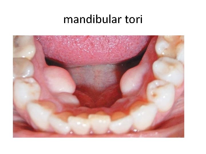 mandibular tori 