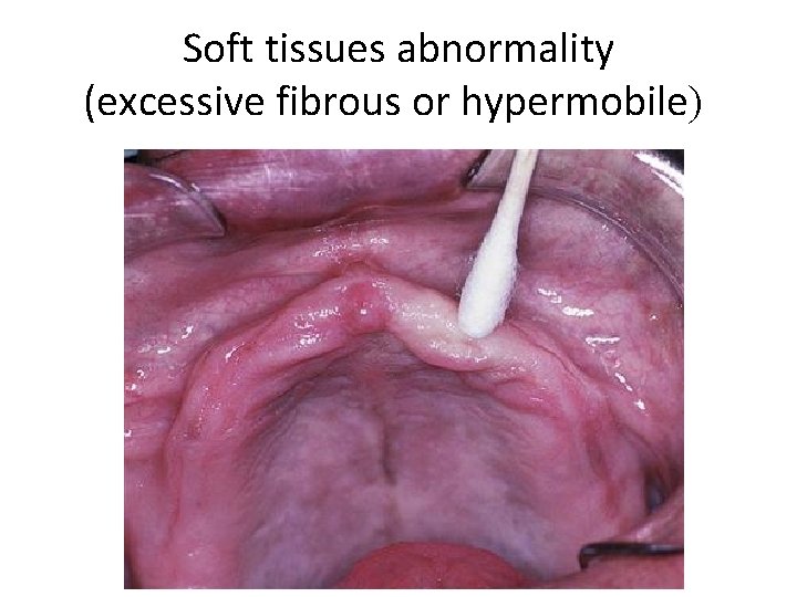 Soft tissues abnormality (excessive fibrous or hypermobile) 
