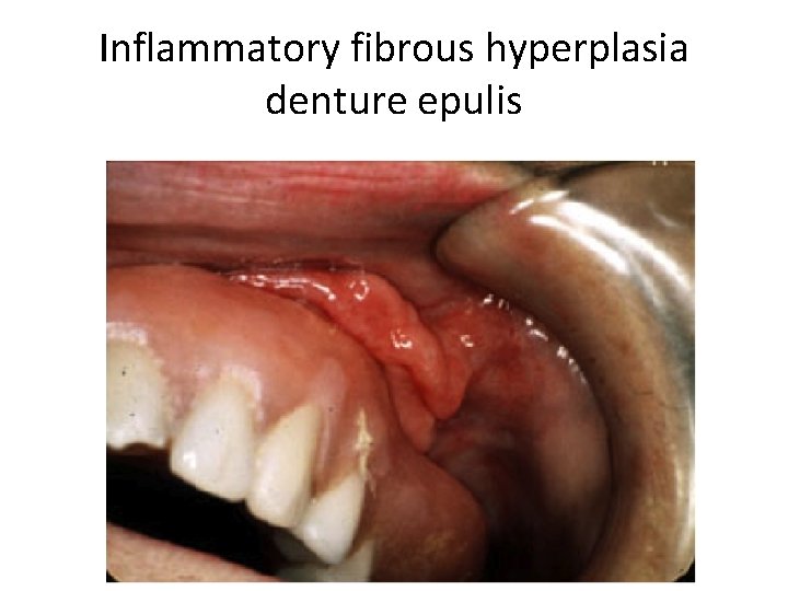 Inflammatory fibrous hyperplasia denture epulis 