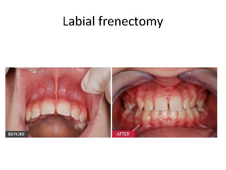 Labial frenectomy 