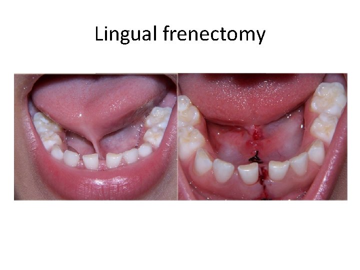 Lingual frenectomy 
