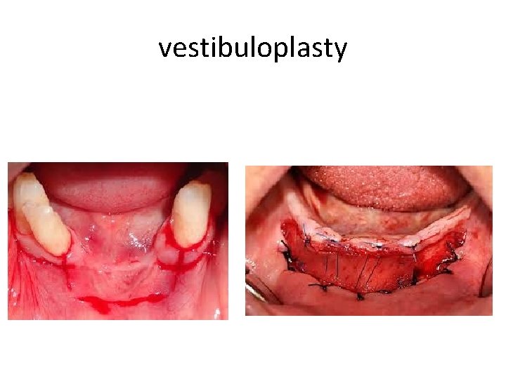 vestibuloplasty 