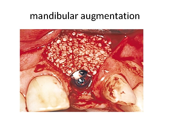 mandibular augmentation 