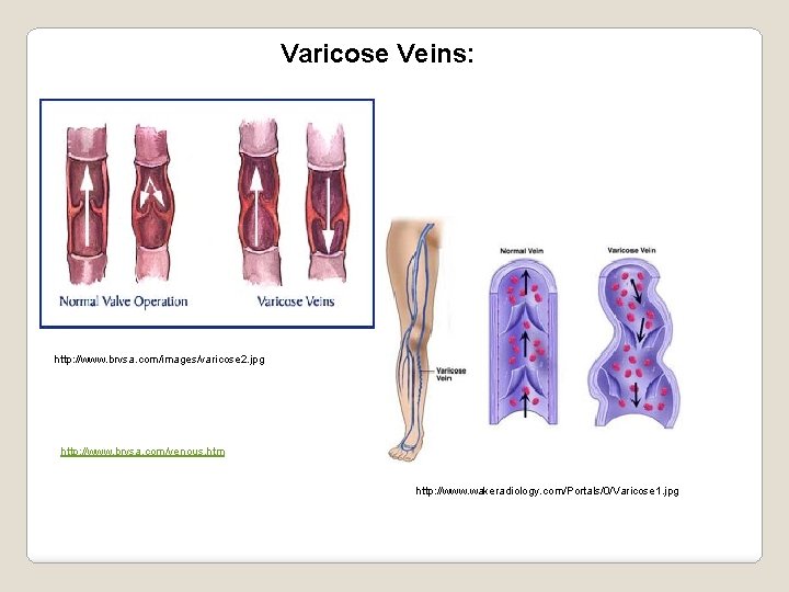 Varicose Veins: http: //www. brvsa. com/images/varicose 2. jpg http: //www. brvsa. com/venous. htm http: